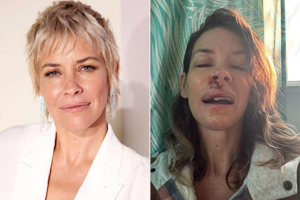 Evangeline Lilly Says She Has Brain Damage, Decreased Function After Concussion