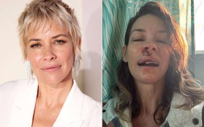 Evangeline Lilly Says She Has Brain Damage, Decreased Function After Concussion