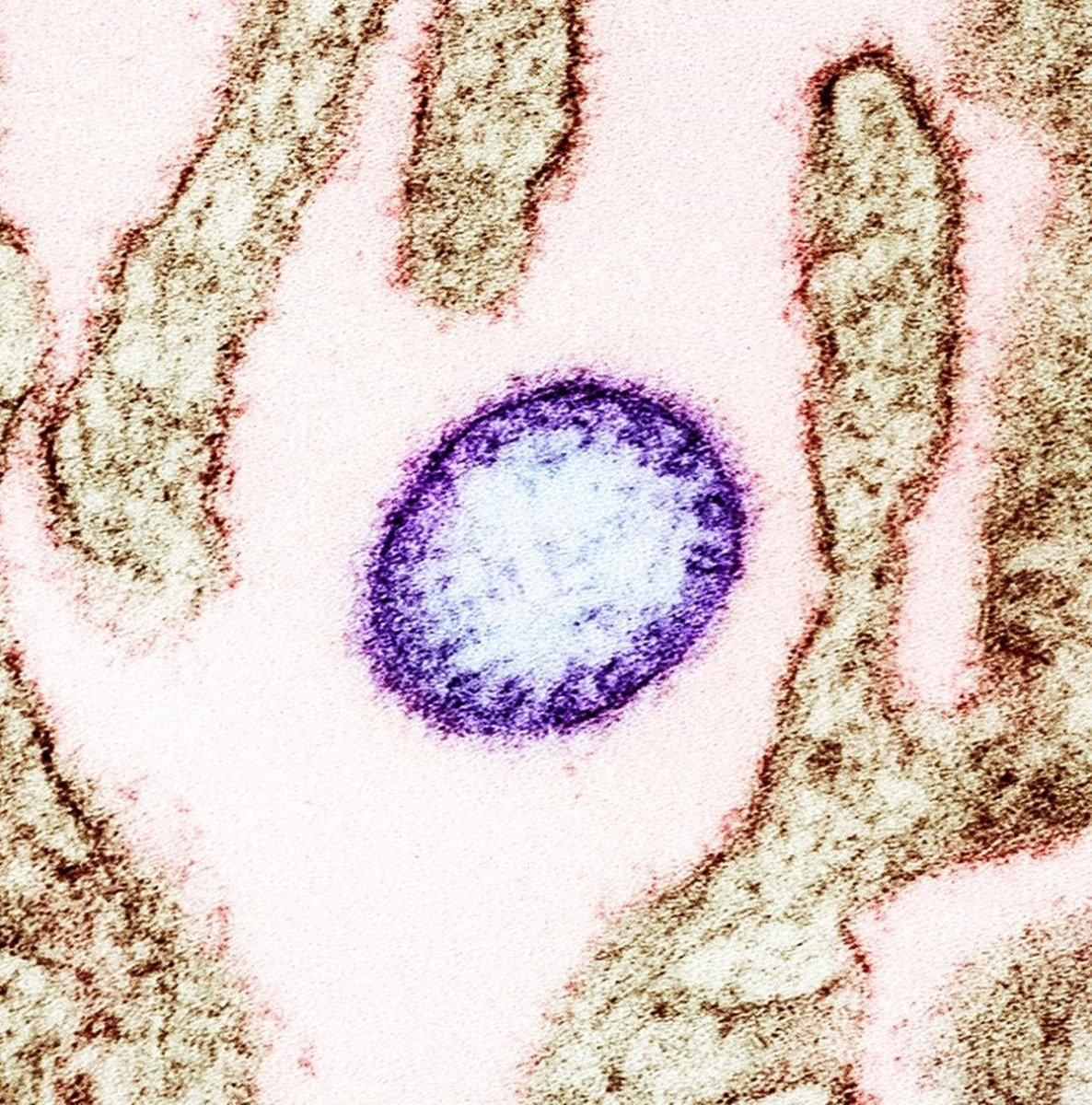 OMS minimizează riscul de răspândire a virusului Nipah din India, în ciuda noilor cazuri raportate Organizația Mondială a Sănătății (OMS) a emis vineri o declaratie în care afirmă că pericolul de răspândire a virusului Nipah din India a fost redus semnificativ, în ciuda apariției recente a două cazuri de infectare într-una dintre cele mai populate țări ale Asiei de Sud