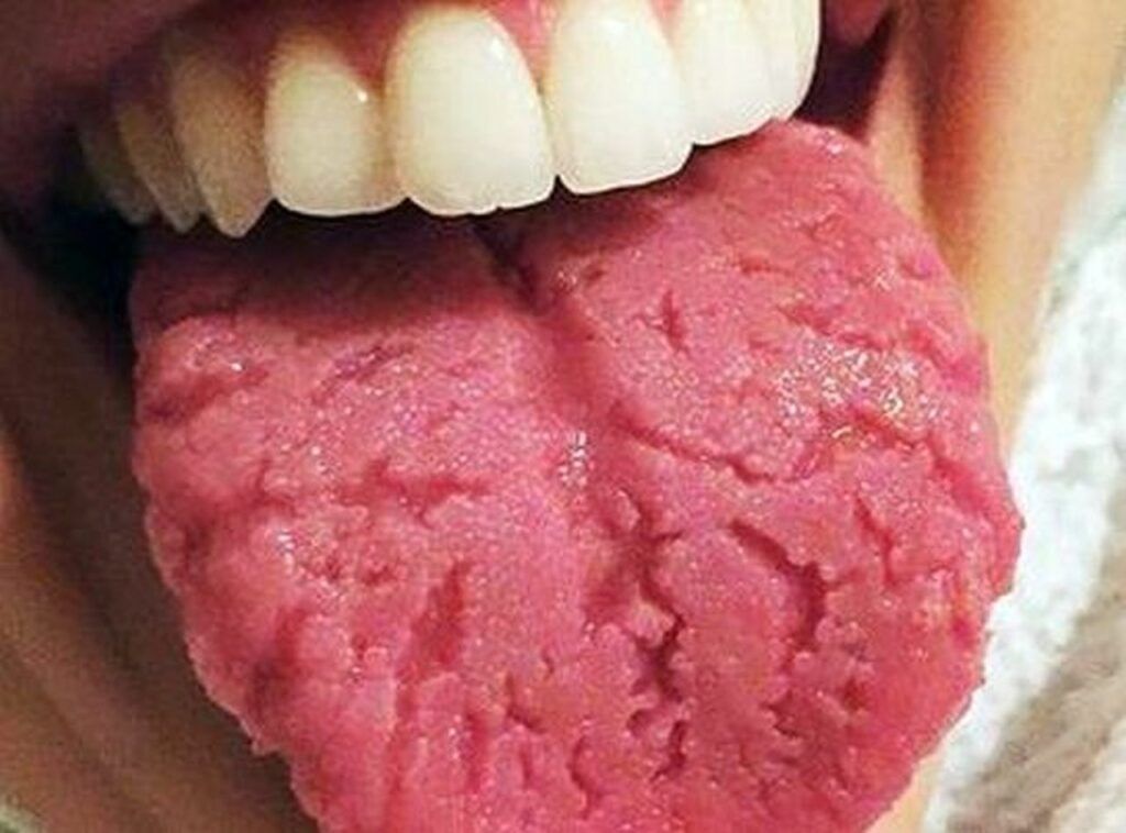 Limba crăpată, un simptom adesea trecut cu vederea, poate fi un indicator important al sănătății interne