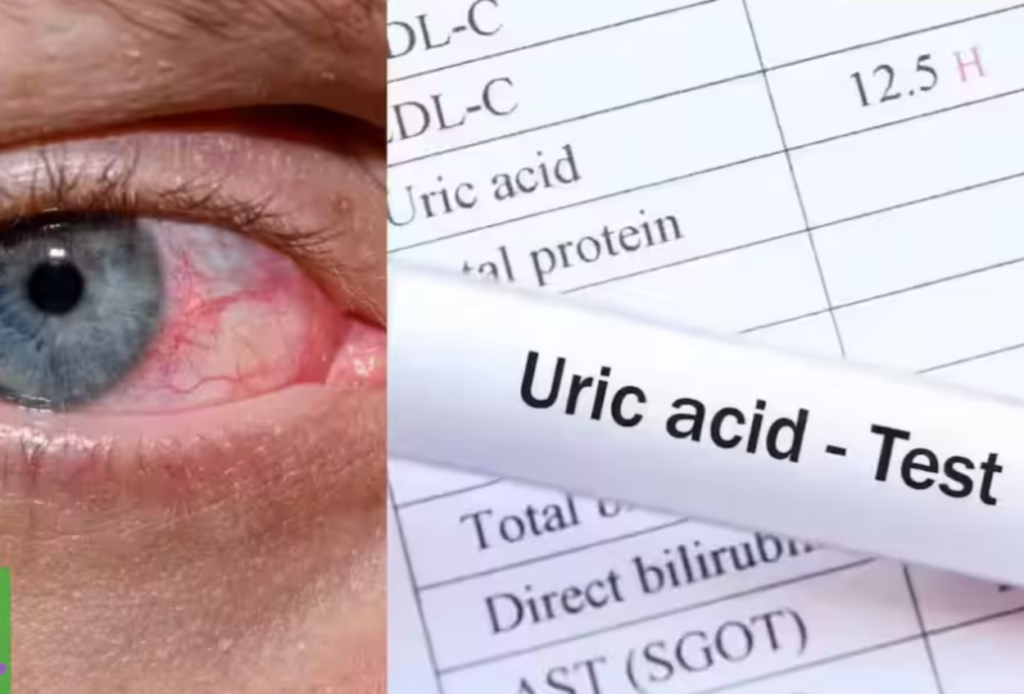 Acidul uric crescut, o problemă tot mai frecventă în societatea modernă, poate avea consecințe serioase asupra sănătății