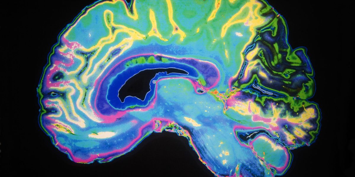 Descoperire revoluționară în lupta contra Alzheimer: cum anume unii neuroni reușesc să reziste mai mult acumulării de tau Cercetările recente realizate de echipe ale UCLA Health și UC San Francisco aduc lumină asupra unui mister major al neurologiei moderne: de ce unii neuroni sunt mai rezistenți decât alții la deteriorările provocate de acumularea de proteina tau, o componentă toxică implicată în dezvoltarea bolii Alzheimer