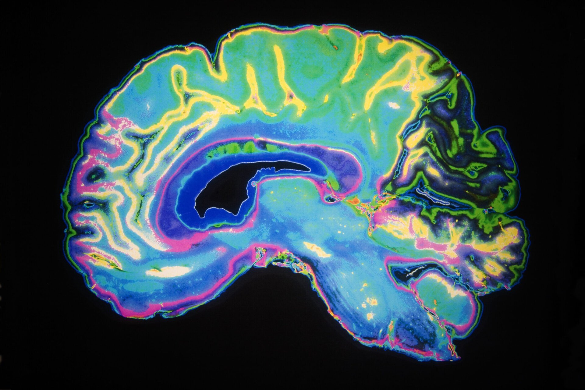 Descoperire revoluționară în lupta contra Alzheimer: cum anume unii neuroni reușesc să reziste mai mult acumulării de tau Cercetările recente realizate de echipe ale UCLA Health și UC San Francisco aduc lumină asupra unui mister major al neurologiei moderne: de ce unii neuroni sunt mai rezistenți decât alții la deteriorările provocate de acumularea de proteina tau, o componentă toxică implicată în dezvoltarea bolii Alzheimer