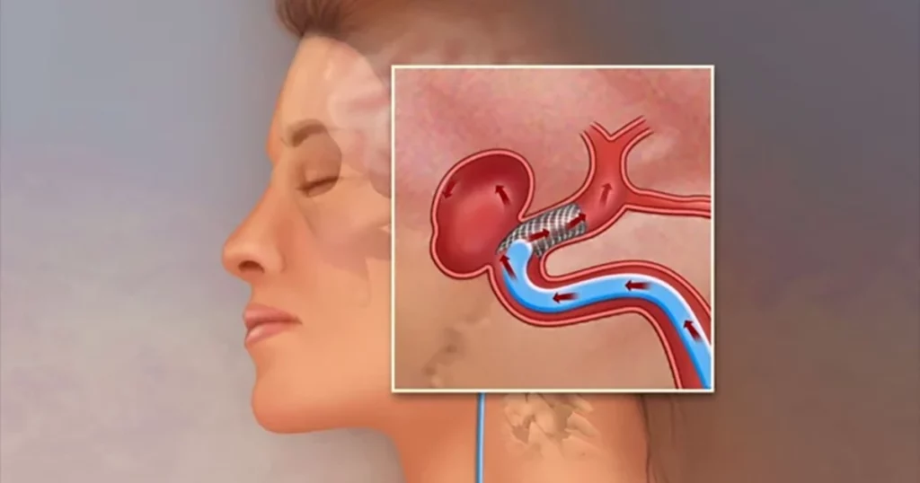 Atenție maximă! Două simptome pot semnala prezența unui anevrism cerebral, o condiție potențial letală, și nu trebuie niciodată ignorate