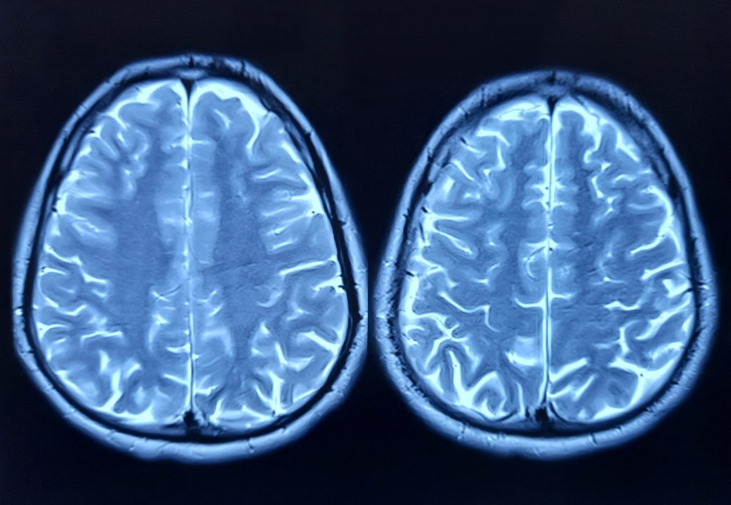 Cercetare revoluționară: celule cerebrale umane conectate la cipuri de siliciu controlează și joacă în Doom Un progres remarcabil în domeniul inteligenței artificiale și biotehnologie a fost anunțat recent, odată cu demonstrarea faptului că celulele cerebrale umane, conectate la hardware din siliciu, pot nu doar să comunice cu calculatorul, ci și să execute sarcini complexe precum jocul video Doom
