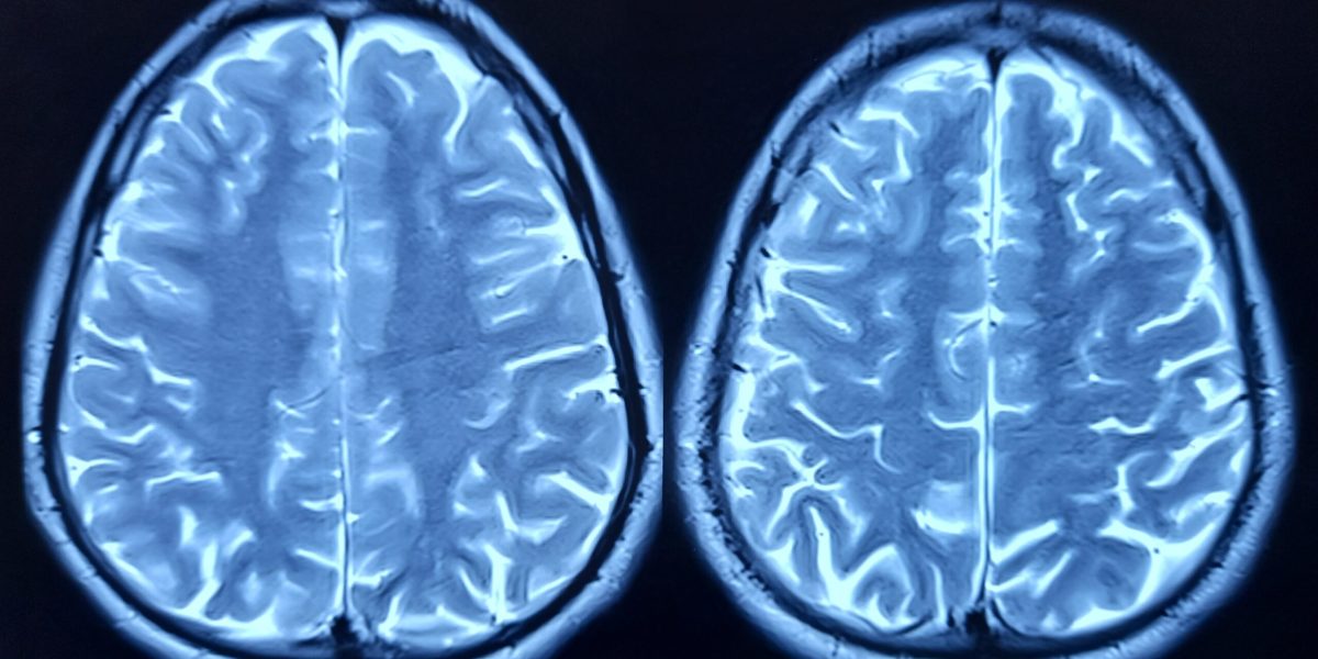 creier-celule-cerebrale-shutter_Descopera-scaled.jpg - StiriAlese