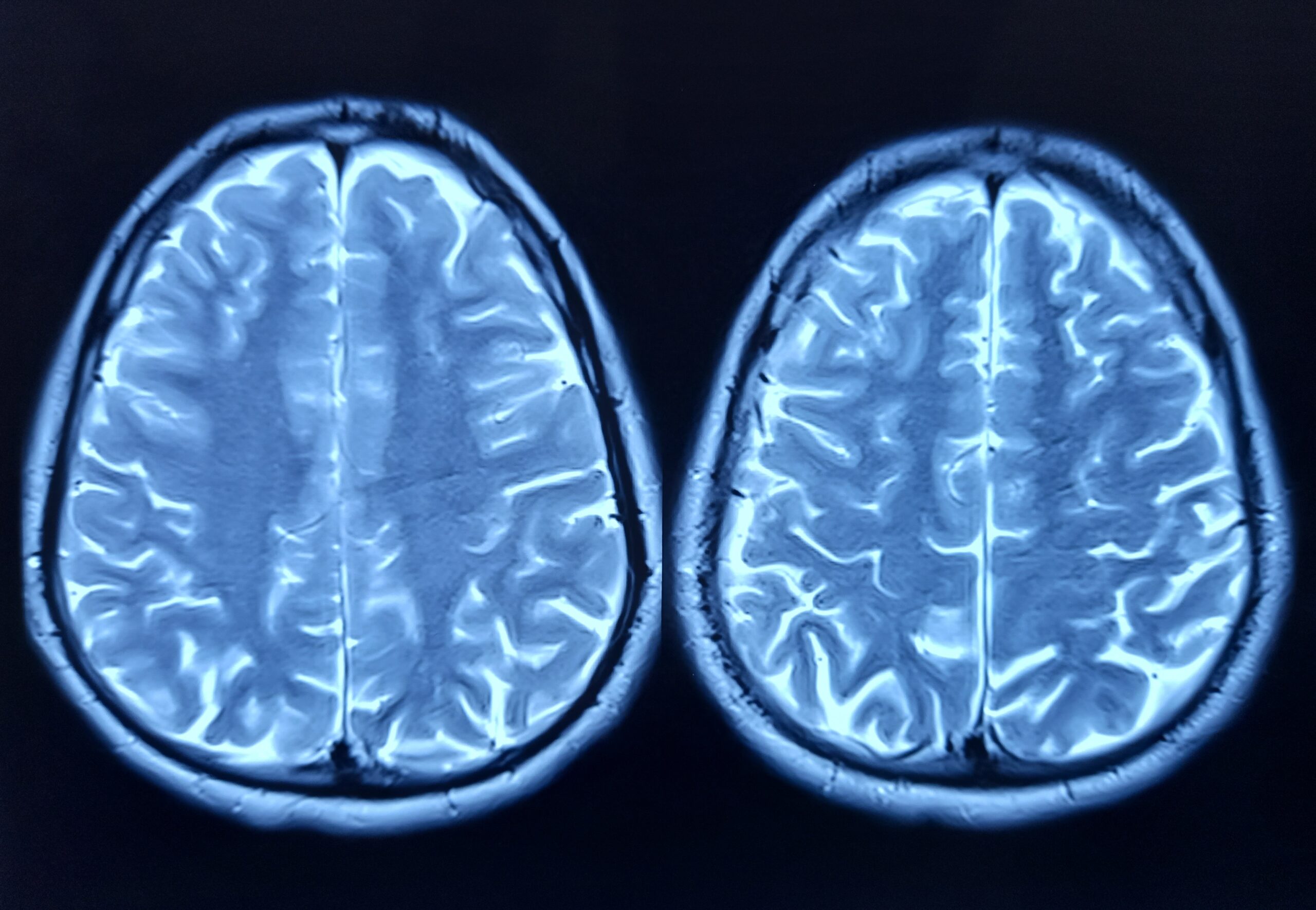 Cercetare revoluționară: celule cerebrale umane conectate la cipuri de siliciu controlează și joacă în Doom Un progres remarcabil în domeniul inteligenței artificiale și biotehnologie a fost anunțat recent, odată cu demonstrarea faptului că celulele cerebrale umane, conectate la hardware din siliciu, pot nu doar să comunice cu calculatorul, ci și să execute sarcini complexe precum jocul video Doom
