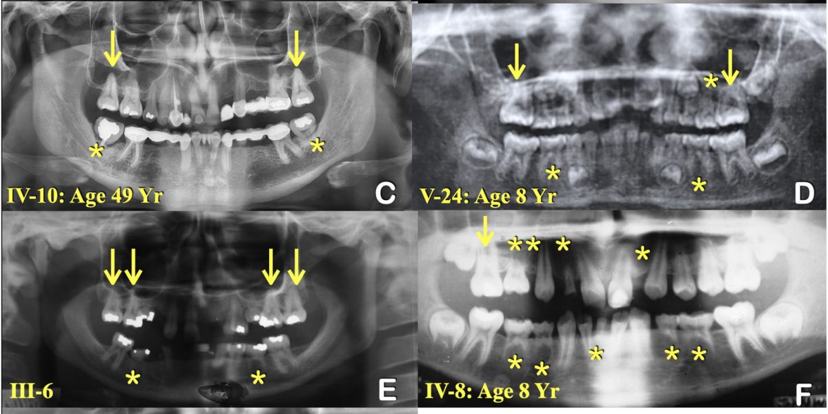 mutatia-genetica-din-spatele-misterioasei-lipse_Graham-Jr-et-al_International-Dental-Journal-2025_de.jpeg - StiriAlese