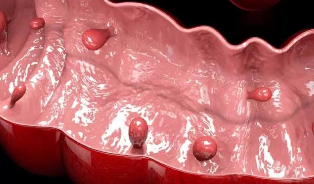 polipi-rectali1-1024x753.jpg - StiriAlese