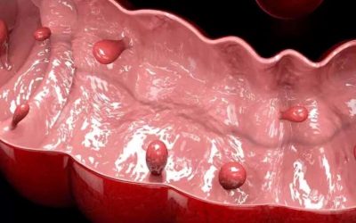 polipi-rectali1-1024x753.jpg - StiriAlese