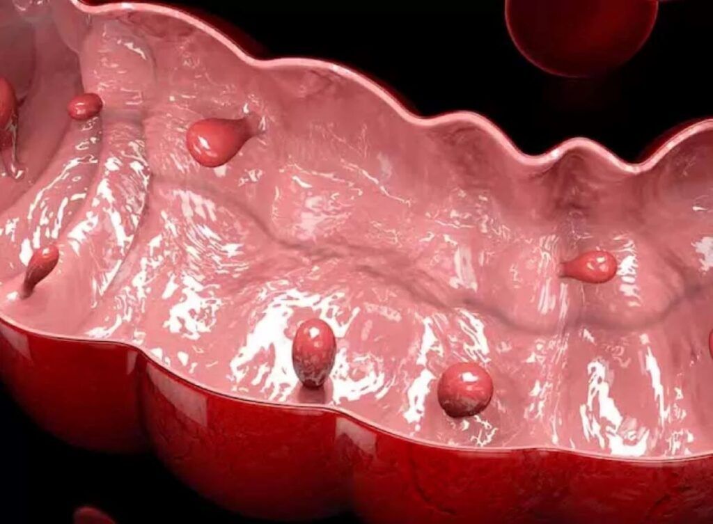 Polipii sesili, excrescențe adesea silențioase, reprezintă o problemă de sănătate ascunsă, ce poate evolua către forme periculoase dacă nu este detectată și tratată la timp