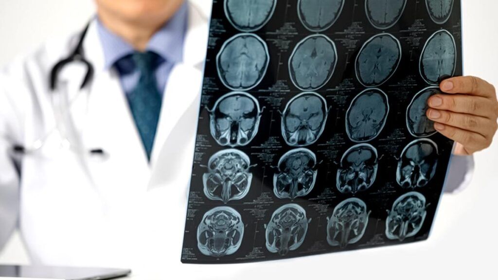 preventie-avc-1024x576.jpg - StiriAlese