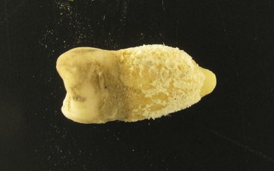 Bacteria scarlatinei, găsită într-o mumie! Descoperirea zguduie lumea medicală