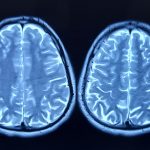 Cercetătorii au identificat factorii rapid care accelerează îmbătrânirea creierului