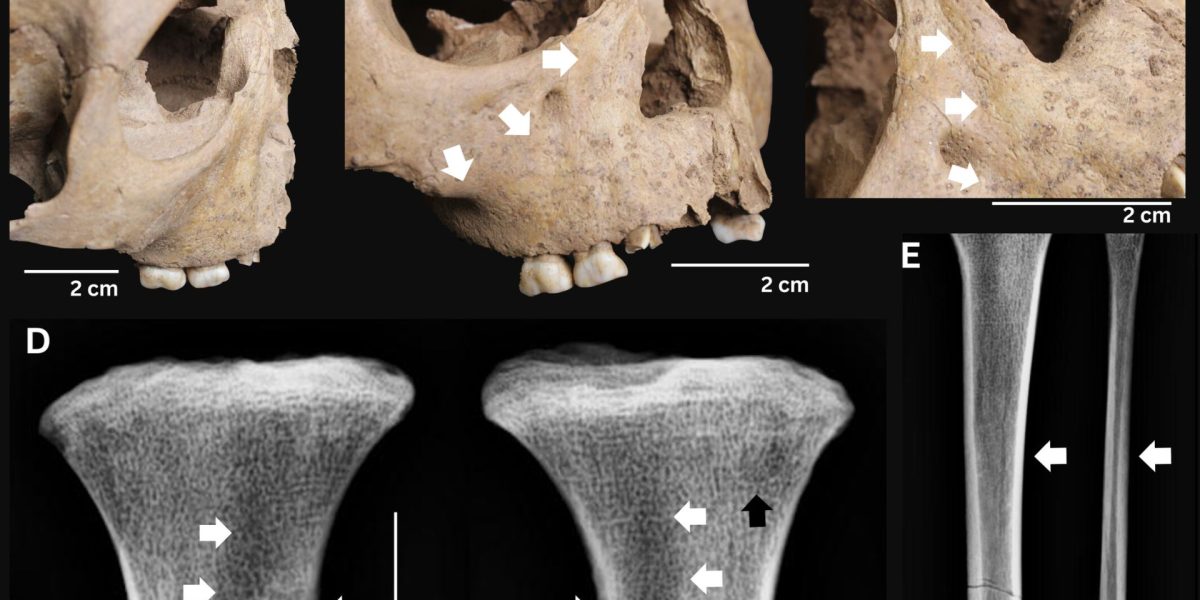 Dinții copiilor antici dezvăluie o boală extrem de gravă de acum 4.000 de ani