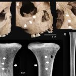 Dinții copiilor antici dezvăluie o boală extrem de gravă de acum 4.000 de ani