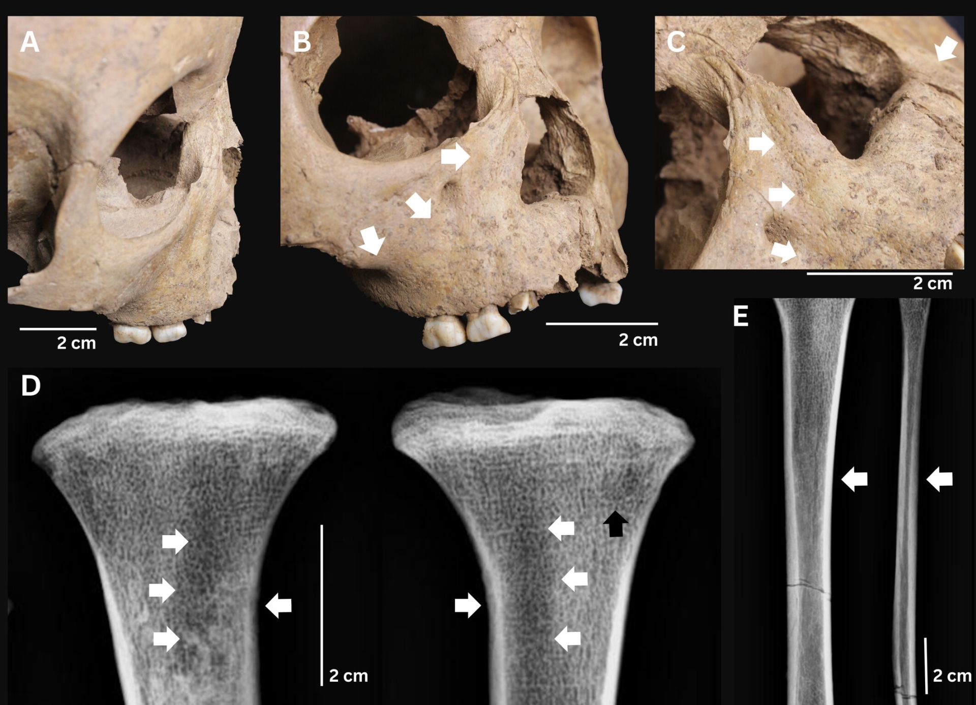 Arheologii din Vietnam au făcut o descoperire care ar putea schimba înțelegerea globală a originii sifilisului, identificând semne ale unei boli debilitante în scheletele a trei copii din Epoca de Piatră