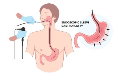 Micșorare de stomac FĂRĂ operație: Noua metodă endoscopică te scapă de kilograme
