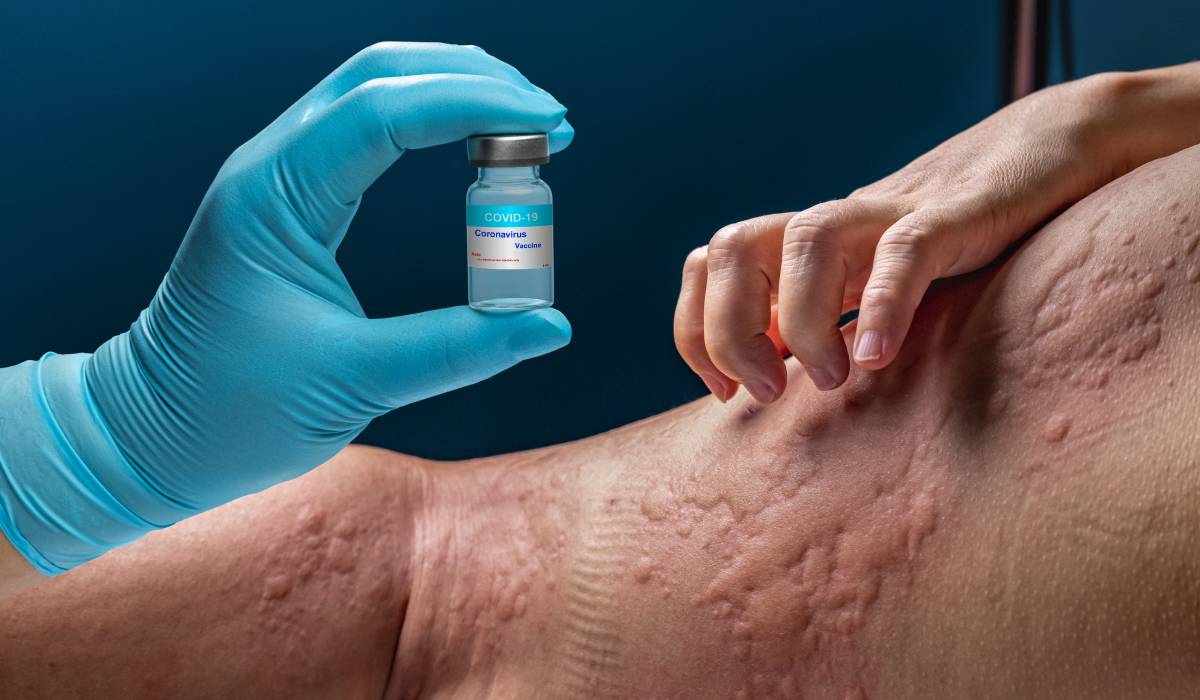 O tânără din România trăiește de peste un deceniu cu peste 40 de alergii, dar recent a reușit să își redobândească unele dintre plăcerile simple ale vieții, precum consumul de măr