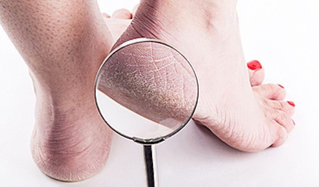 Culoarea călcâielor, semn de boală gravă la ficat: Avertismentul unui medic