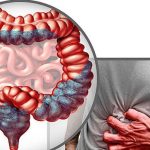 Mâncarea banală ce sporește riscul de cancer de colon: Adevărul ignorat