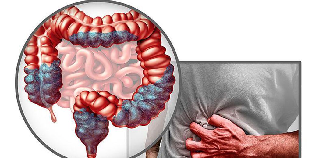 Mâncarea banală ce sporește riscul de cancer de colon: Adevărul ignorat