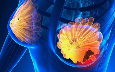 Semnele cancerului de sân: 5 simptome la care trebuie să fii atentă!