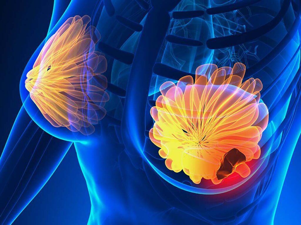 Semnele cancerului de sân: 5 simptome la care trebuie să fii atentă!