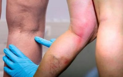 Vitamina-minune: Previne cheagurile și întărește imunitatea