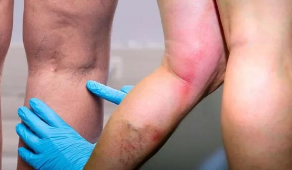 Vitamina-minune: Previne cheagurile și întărește imunitatea