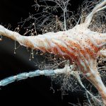 Inflamația intestinală, legătură directă cu scleroza multiplă? Un studiu alarmant