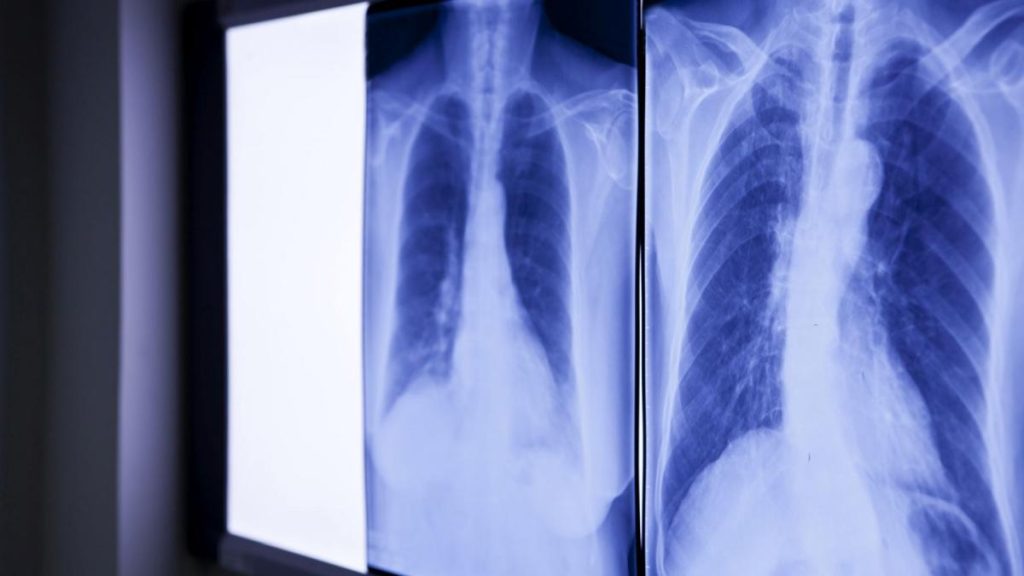 Bărbat, operat de urgență: Medicii, ȘOCAȚI de ce au găsit în abdomen după 20 de ani