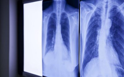 Bărbat, operat de urgență: Medicii, ȘOCAȚI de ce au găsit în abdomen după 20 de ani