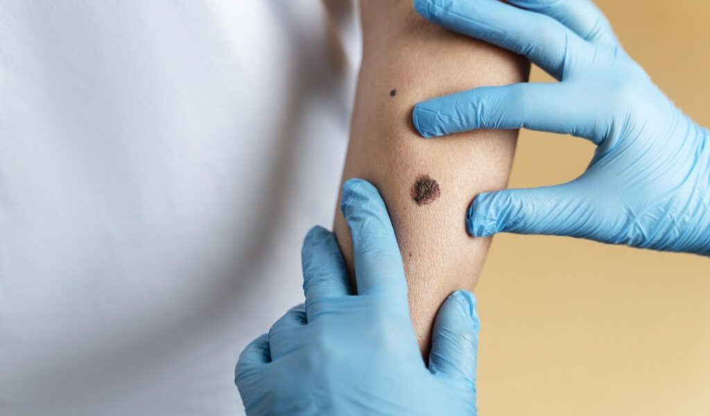 O aluniță fatală: O FEMEIE a murit după o intervenție șocantă