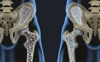 Noul tratament revoluționar: Oase mai puternice și densitate refăcută