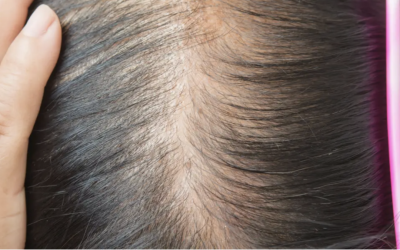 Gras pe scalp? Medic: Poate ascunde o boală ce afectează 1 din 10 femei