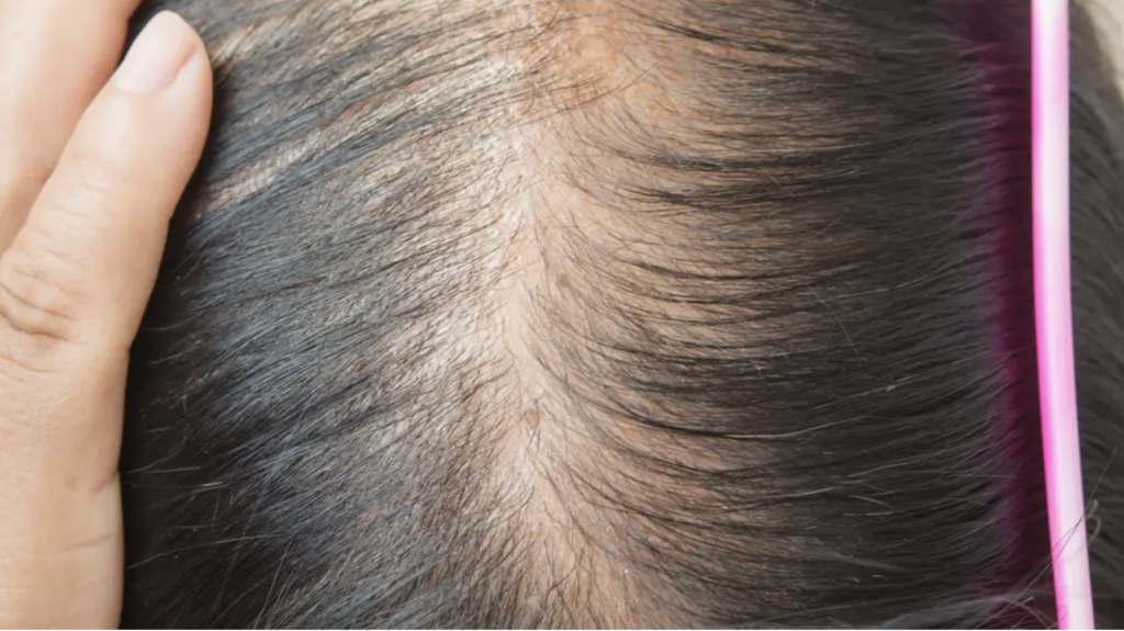 Gras pe scalp? Medic: Poate ascunde o boală ce afectează 1 din 10 femei