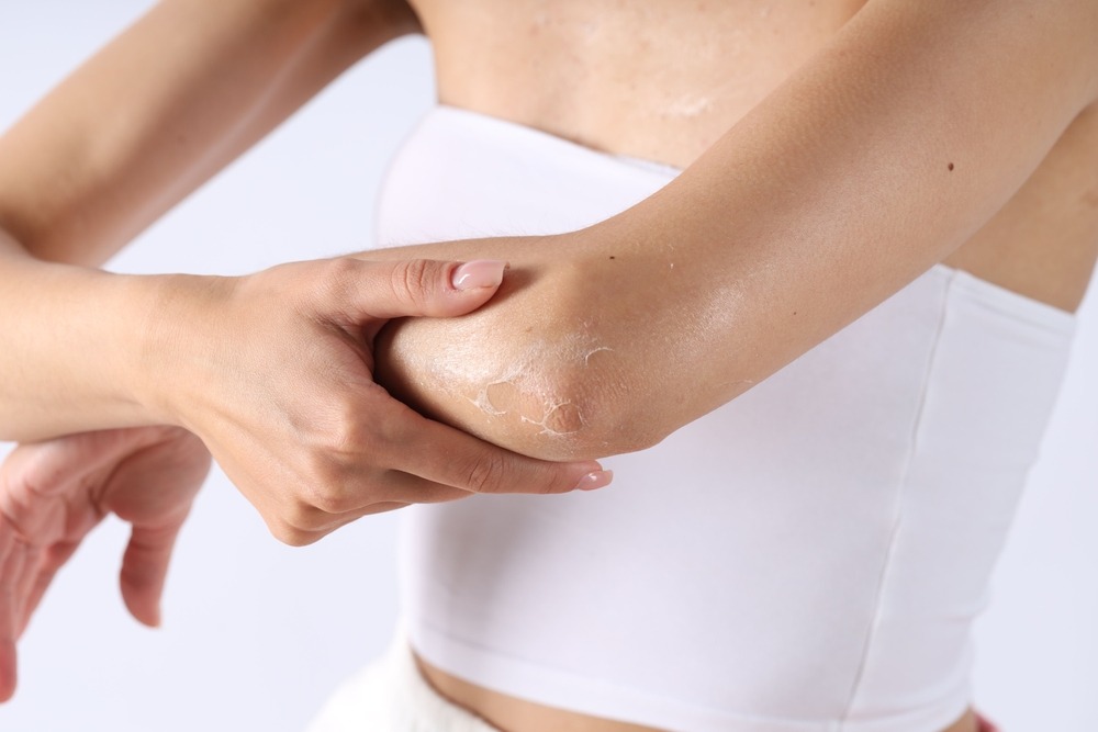 Piele uscată pe brațe și picioare? 5 obiceiuri care agravează problema