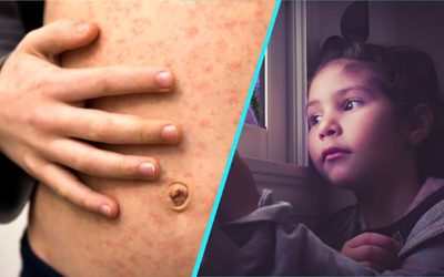 Rujeola: Copiii paralizează și mor. STUDIU care stârnește fiori în România