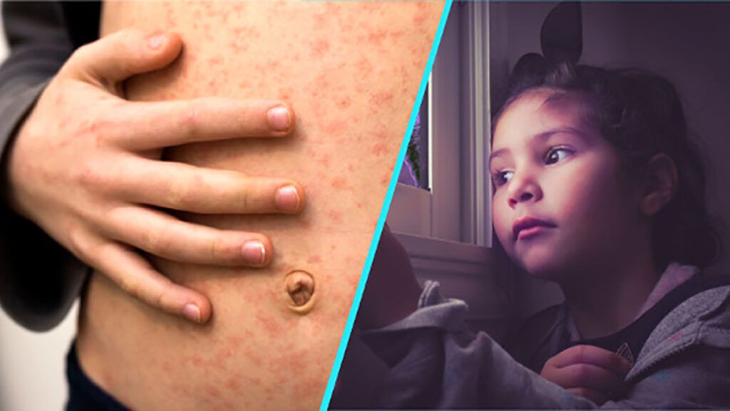 Rujeola: Copiii paralizează și mor. STUDIU care stârnește fiori în România