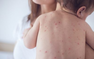 Rujeolă: România, lider UE la îmbolnăviri. „Butoiul cu pulbere” din Europa