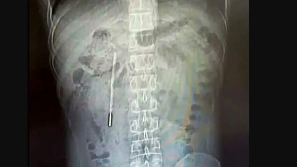 Medici, șocați: Ce au găsit în stomacul unui chinez după 20 de ani de dureri