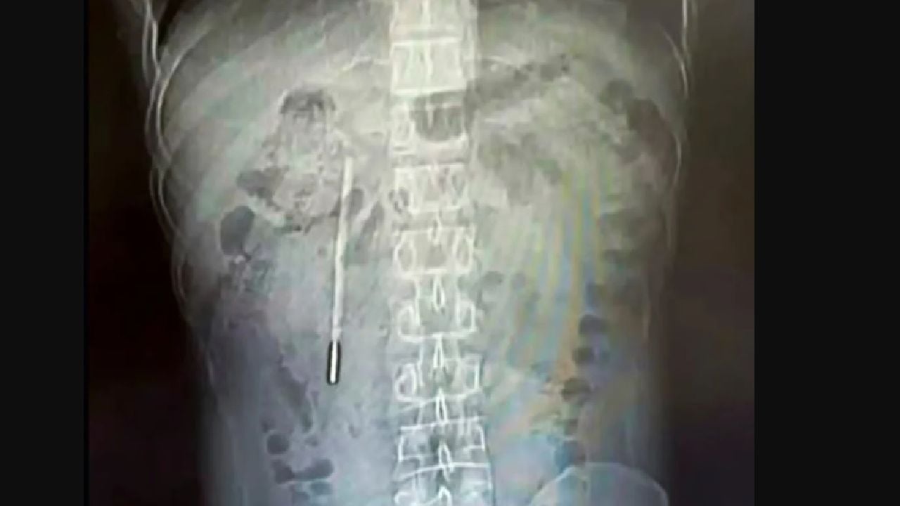 Medici, șocați: Ce au găsit în stomacul unui chinez după 20 de ani de dureri
