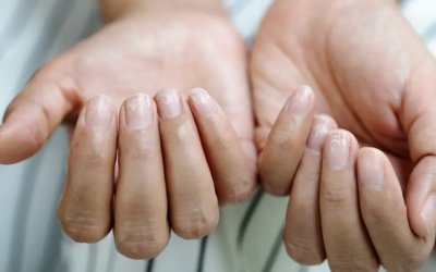 Unghiile „Terry” dezvăluie boli grave: Ce semnalează acestea pentru corpul tău