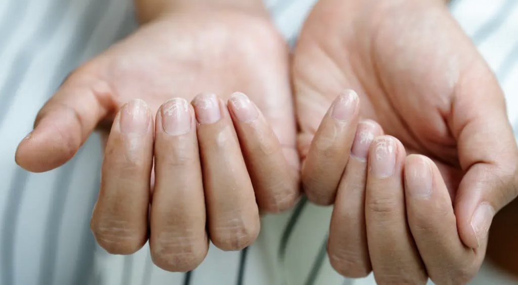 Unghiile „Terry” dezvăluie boli grave: Ce semnalează acestea pentru corpul tău