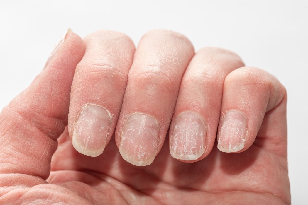 Modificările la nivelul unghiilor pot semnala probleme de sănătate grave, precum afecțiuni ale inimii, ficatului sau rinichilor