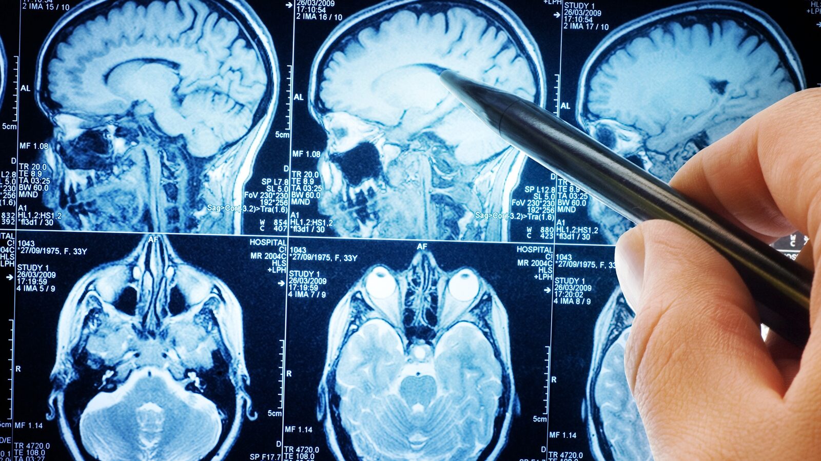 Creierul „vorbește” chiar și-n tăcere. Descoperire medicală majoră