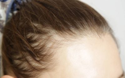 Slăbești, dar îți cade părul? Legătura injecțiilor cu alopecia