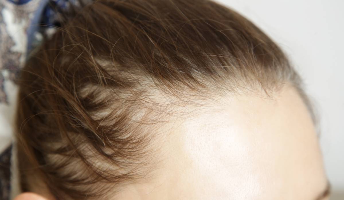 Slăbești, dar îți cade părul? Legătura injecțiilor cu alopecia