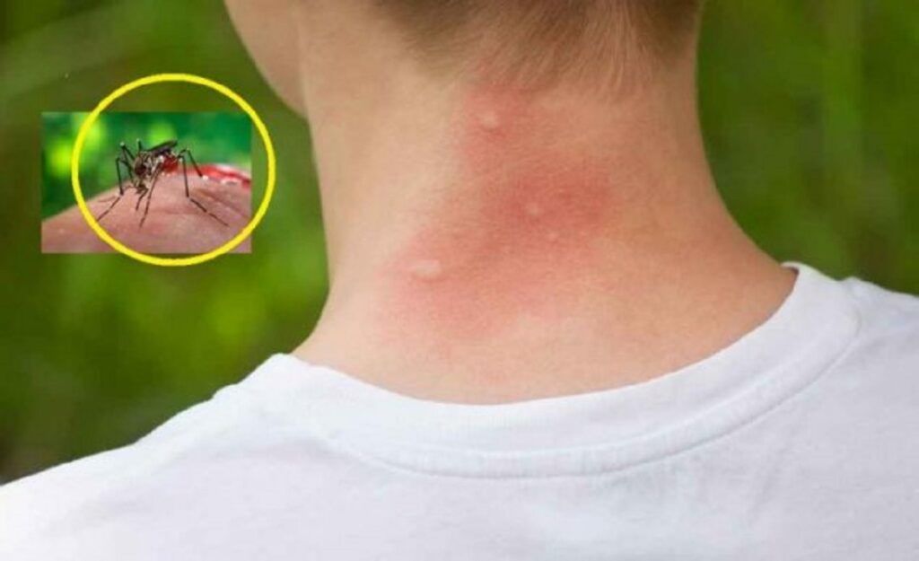Țânțarii te aleg: 3 bacterii secrete!
